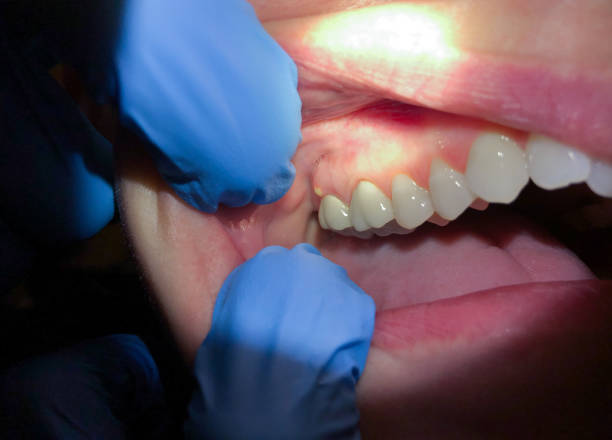 Best Emergency Treatment for Toothache in Chickamau, GA